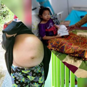 Sangat Butuh Uluran Tangan, Siswi SDN Patarselamat dari Keluarga Tidak Mampu Menderita Penyakit Ginjal dan Paru-paru Bocor