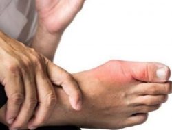 Cara Jitu Redakan Asam Urat Dengan Metode Berikut